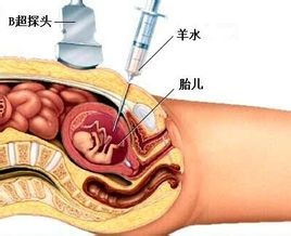 成都哪家医院做羊水穿刺好？