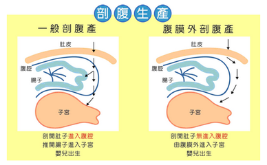 剖腹产要注意什么？